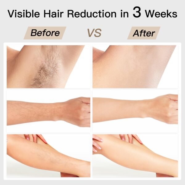 Bosidin D1178 Ice Cooling IPL Hair Removal Device - Image 3